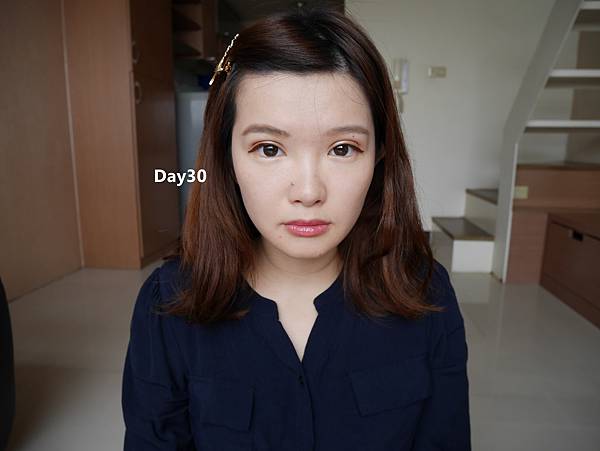 雙眼皮 雙眼皮手術 縫雙眼皮 晶緻