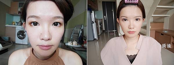 雙眼皮 雙眼皮手術 縫雙眼皮 晶緻