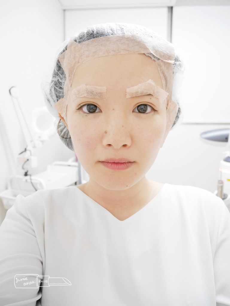 雅偲皮膚科 4D美塑光波拉提 嘴邊肉 法令紋