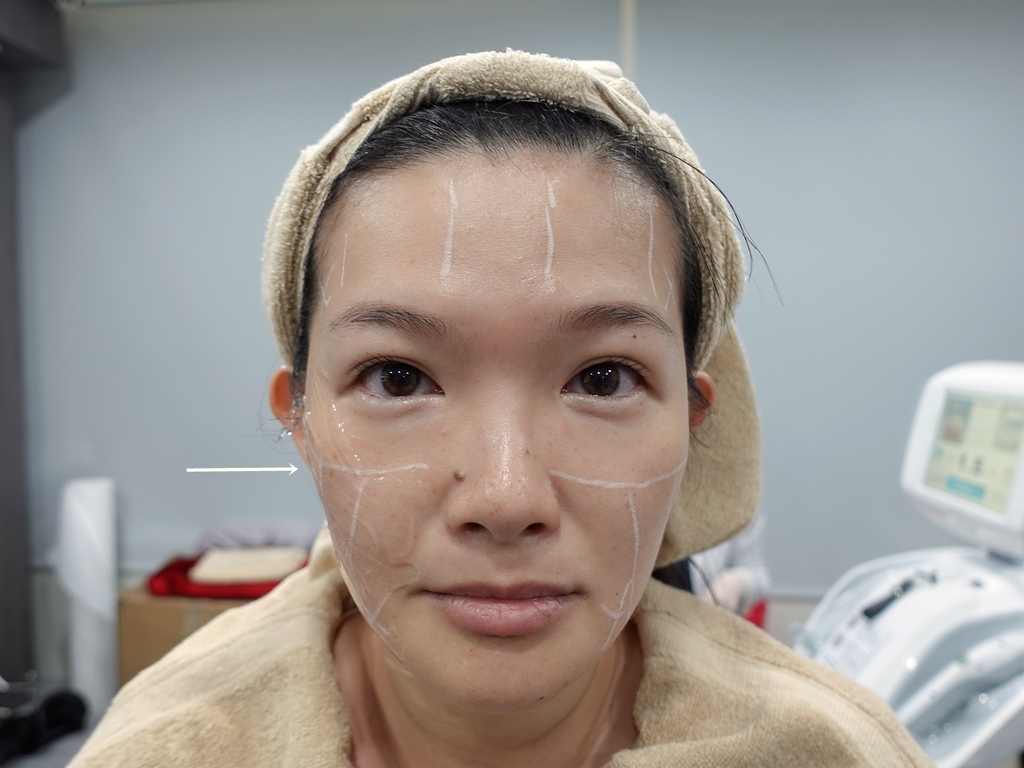 ​​​第三代海芙音波 法令紋 肉鬆.JPG