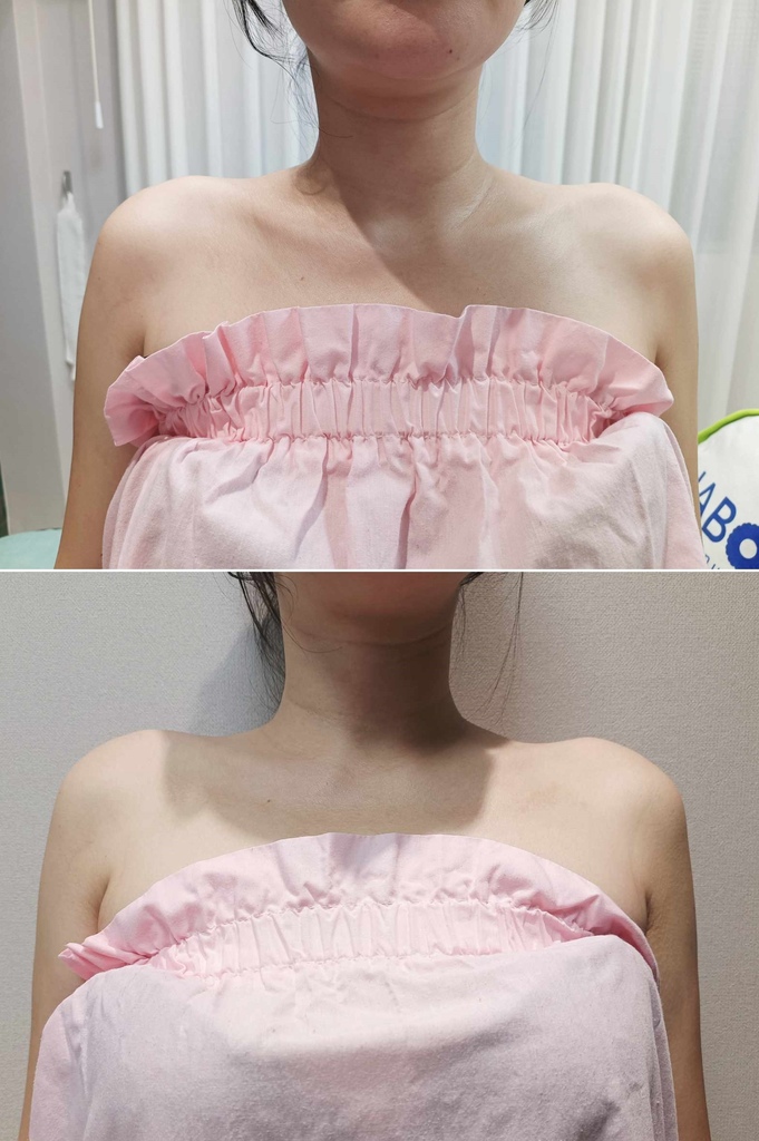 肉毒斜方肌 肉毒肩頸 琢月診所.jpg